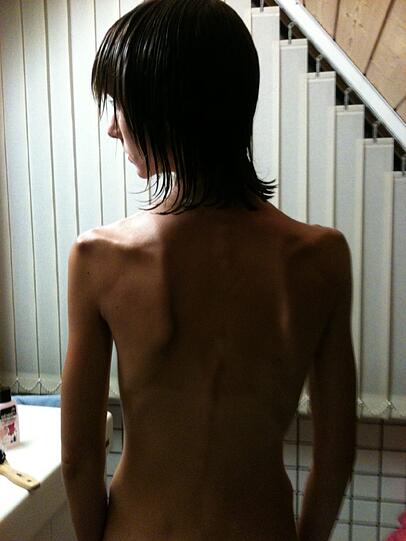 Nur noch Haut und Knochen: Dieses Foto zeigt Nicole Knörr nach einem Rückfall im Jahr 2013. Der AZ vertraut sie im Gespräch an, was sie sich ausgedacht hat, um ihr wahres Gewicht während der stationären Behandlung zu verschleiern: Sie trank zum Beispiel sechs Liter Wasser auf einmal &ndash; oder nähte Münzen in die Unterhose ein. &bdquo;Es ist unglaublich, was sich diese Krankheit einfallen lässt&ldquo;, sagt die junge Frau im Nachhinein.