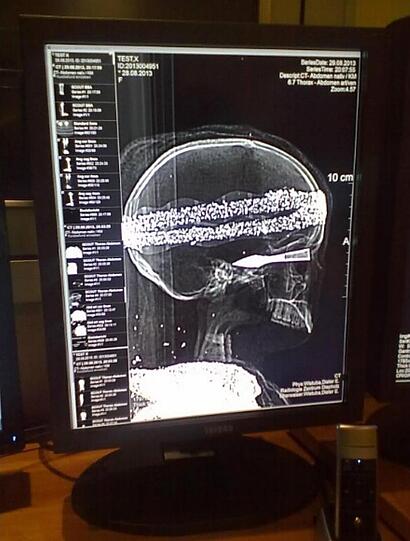 ...Als eine Computertomographie noch einen Pfeil in der Augenhöhle des Skeletts sichtbar machte, wurde der Krimi perfekt. Und dann das: Es stellte sich heraus, dass das Skelett überwiegend aus Plastik bestand, der Schädel war echt &ndash; alles nach Art einer 2000 Jahre alten Mumie eingewickelt.

Der Vater des Jungen brachte es auf den Punkt: &bdquo;Erst sollte es ein historisches Fundstück sein, dann kam der Verdacht eines Verbrechens auf. Und jetzt soll es eine billige Fälschung mit einem Karnevalsskelett und einem Kinderpfeil sein &ndash; mir fällt da eigentlich nichts mehr zu ein.&ldquo; Die Ermittlungen gingen danach weiter.