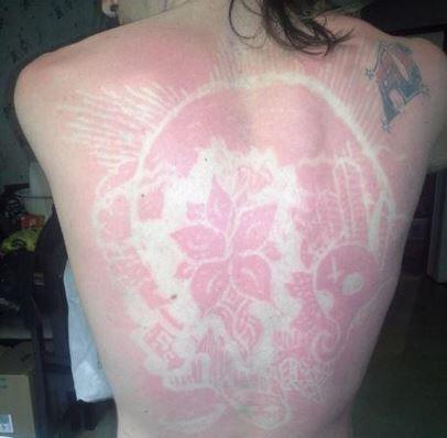 Der #sunburnart-Trend verbreitet sich auf Twitter rasend schnell. Hautärzte warnen vor den Gefahren.
