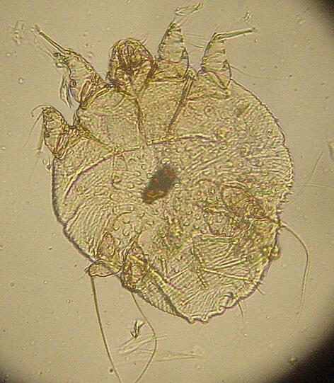 Scabies, winzige Krätzmilben, graben sich in die obere Hornschicht der Haut ein.
