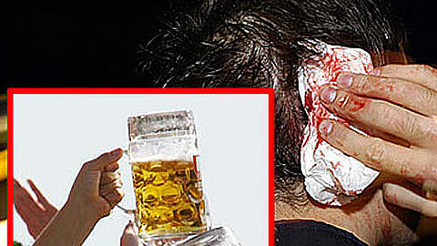 Lebensgefährliche Attacke: Am Kopf des Opfers klafft eine blutende Wunde nach einem Angriff mit einem Bierkrug.