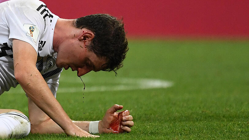Nach dem unglücklichen Zusammenprall hat sich Sebastian Rudy die Nase gebrochen. Nach dem unglücklichen Zusammenprall hat sich Sebastian Rudy die Nase gebrochen.