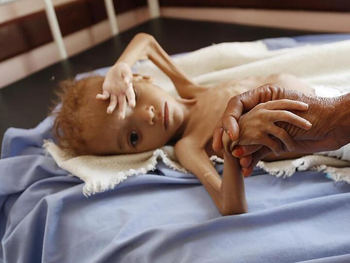 Eine Frau hält die Hand eines stark unterernährten Kindes in einem Krankenhaus in der jemenitischen Provinz Hadscha.