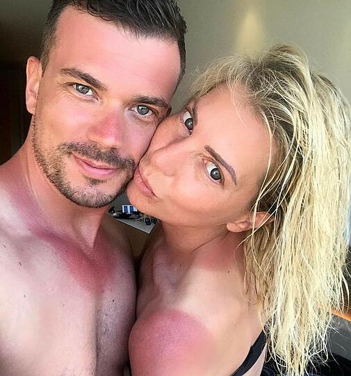 Giulia Siegel und ihr Freund Ludwig Heer zeigen ihrer heftigen Sonnenbrand
