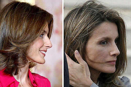 Prinzessin Letizia von Spanien hat sich wegen ihrer Nase unters Messer begeben. Angeblich nur, um Atembeschwerden zu beheben, sagten Palastsprecher.