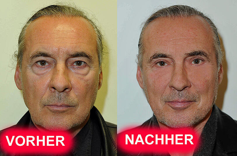 Im direkten Vergleich: Ex-Glücksrad-Moderator Peter Bond vor und nach der Behandlung.