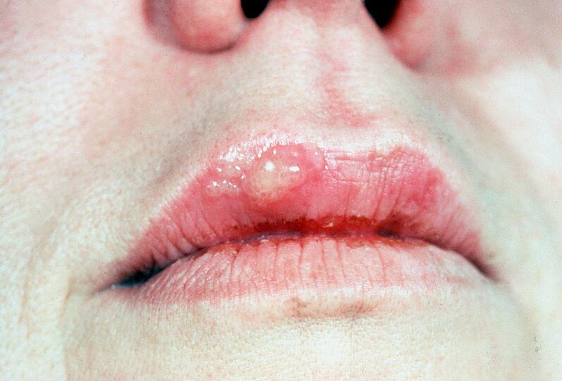 Häßliche Bläschen an der Lippe: Herpes kann jeden treffen.