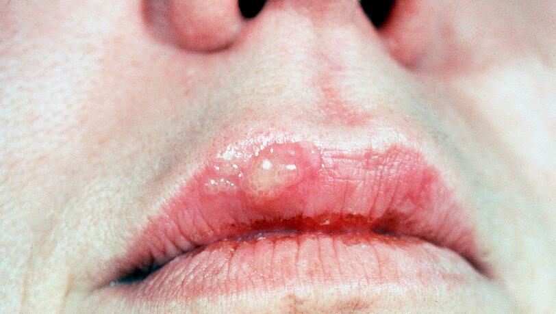 Häßliche Bläschen an der Lippe: Herpes kann jeden treffen. Häßliche Bläschen an der Lippe: Herpes kann jeden treffen.