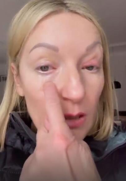 Monika Gruber hat sich einen Riss in der Hornhaut zugezogen. Im anderen Auge hat sich ein Gerstenkorn gebildet. Monika Gruber hat sich einen Riss in der Hornhaut zugezogen. Im anderen Auge hat sich ein Gerstenkorn gebildet.