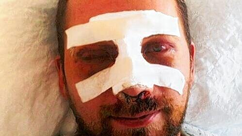 Grün und blau geschlagen: Tobias B. nach der Attacke im Klinikum rechts der Isar. Grün und blau geschlagen: Tobias B. nach der Attacke im Klinikum rechts der Isar.