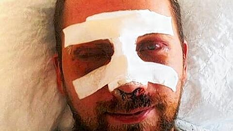 Grün und blau geschlagen: Tobias B. nach der Attacke im Klinikum rechts der Isar.