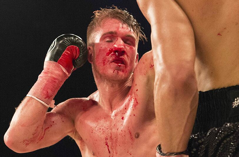 Nick Blackwell (Foto) hat bei seinem Kampf gegen Chris Eubank junior eine Hirnblutung davongetragen.