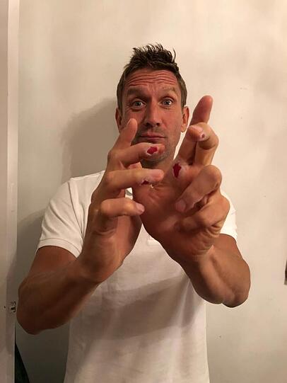 Peer Kusmagk zog sich schwere Verbrennungen von Seilen und Stangen an den Fingern zu.