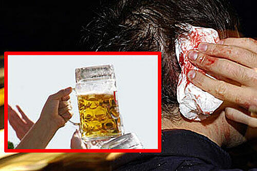 Lebensgefährliche Attacke: Am Kopf des Opfers klafft eine blutende Wunde nach einem Angriff mit einem Bierkrug. (Symbolbild)