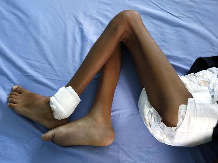 Ein unterernährtes Kind liegt in einem Krankenhaus in Hudaida. Millionen von Menschen hungern im Jemen.