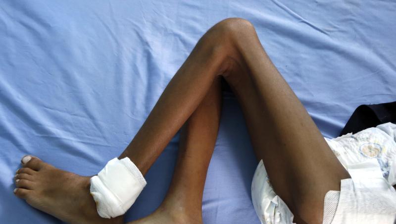 Ein unterernährtes Kind liegt in einem Krankenhaus in Hudaida. Millionen von Menschen hungern im Jemen. Ein unterernährtes Kind liegt in einem Krankenhaus in Hudaida. Millionen von Menschen hungern im Jemen.