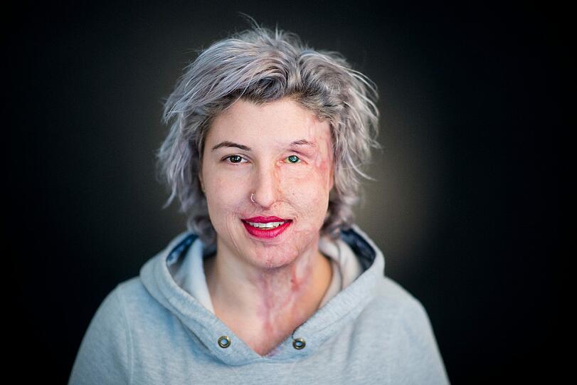 Sich in der Öffentlichkeit verstecken? Für Vanessa keine Option - sie steht zu ihren Narben.