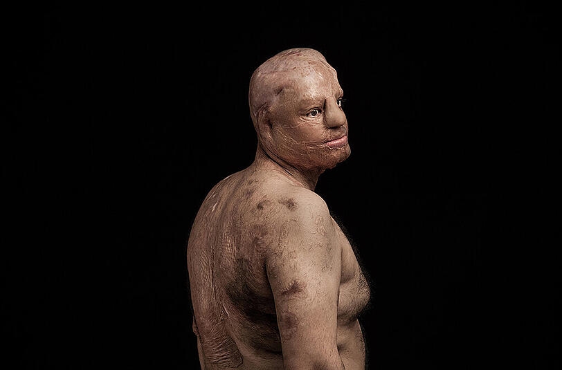 In seiner Serie "Fire of Hatred", also "Feuer des Hasses", befasst sich der iranische Fotojournalist Asghar Khamseh mit den Opfern von Säureanschlägen.