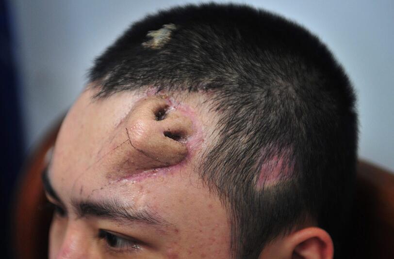 Es ist der erste medizinische Eingriff dieser Art. Ärzte in China haben eine künstliche Nase auf der Stirn eines 22-Jährigen gezüchtet, der seine Nase durch einen Unfall verloren hatte.