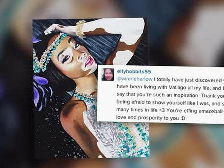 Model Chantelle Brown-Young leidet unter einer Pigmentstörung
