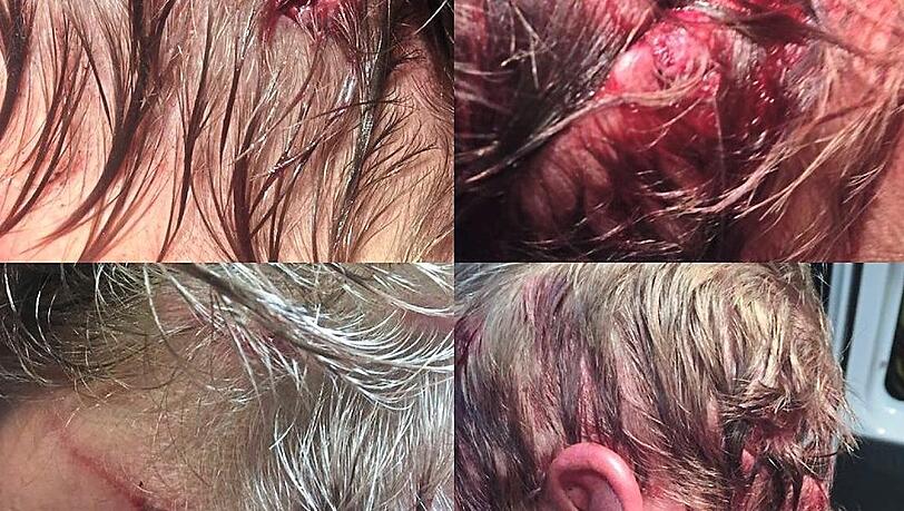 So hat Dylan McWilliams nach dem Bärenangriff ausgesehen. So hat Dylan McWilliams nach dem Bärenangriff ausgesehen.
