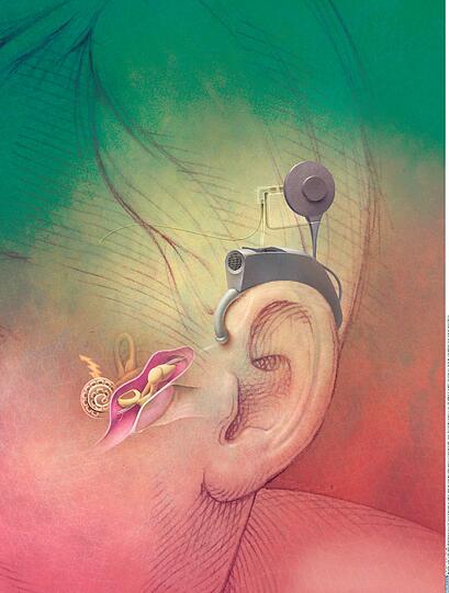 Diese Hörprothese lässt taube Menschen hören: So sieht ein Cochlear Implantat aus.