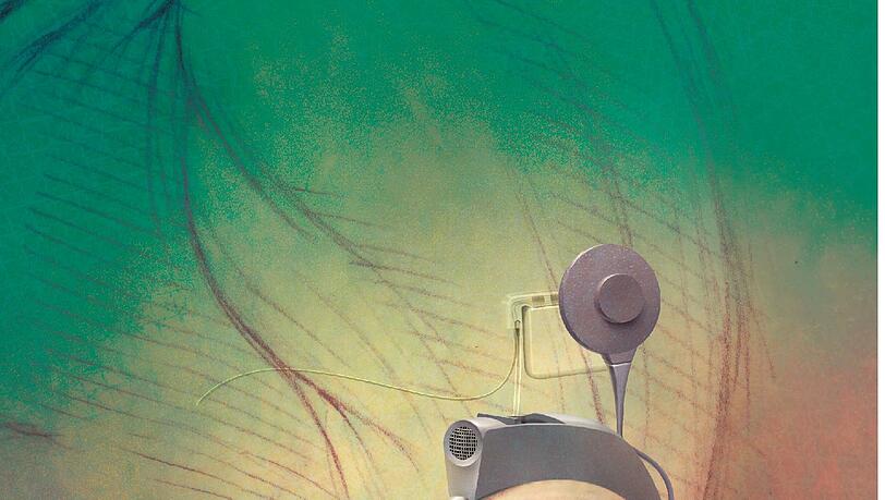 Diese Hörprothese lässt taube Menschen hören: So sieht ein Cochlear Implantat aus. Diese Hörprothese lässt taube Menschen hören: So sieht ein Cochlear Implantat aus.