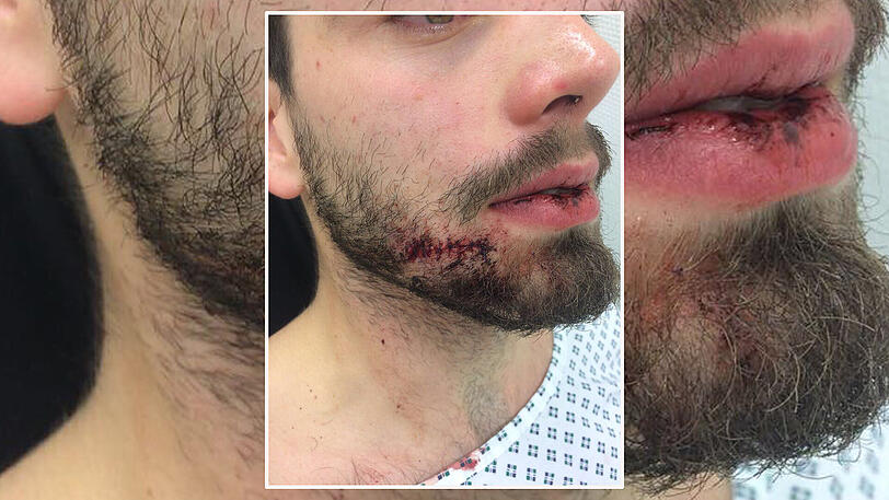 Das Loch in der Wange wurde mit 18 Stichen genäht.