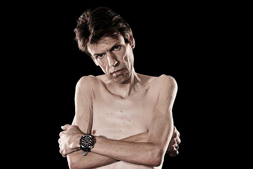 39 Kilo bei 1,84 Meter Größe &ndash; 2009 stand der magersüchtige Sportmanager Christian Frommert kurz vor dem Nierenversagen. Grammweise geht es seitdem bergauf.