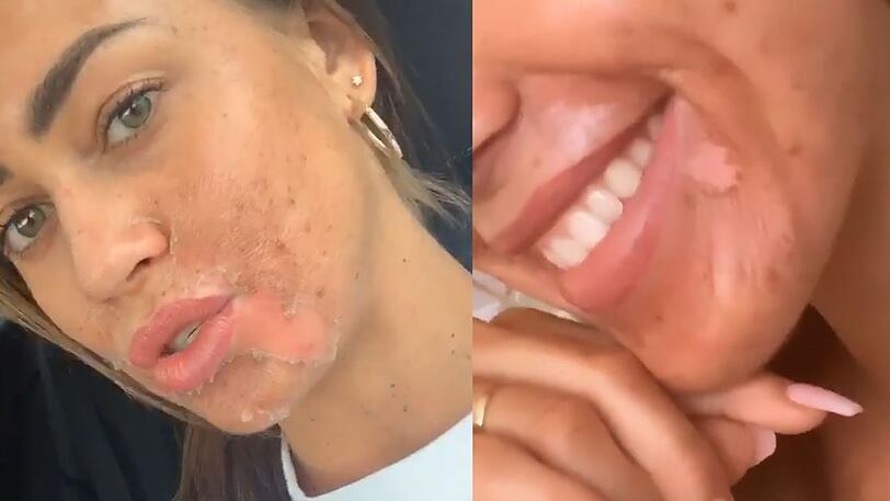 Die Haut spannt und löst sich in Fetzen ab! Was ist denn da bei Jessica Paszka los?