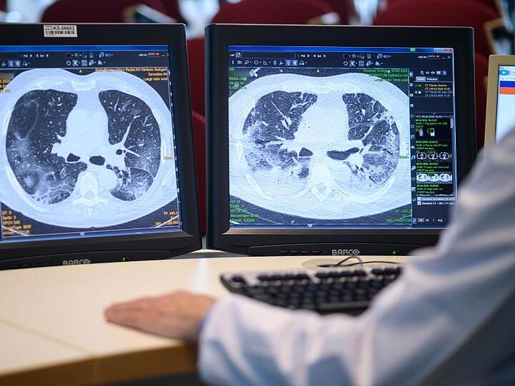 Computertomographieaufnahmen zeigen die Lunge eines Covid-19-Patienten.