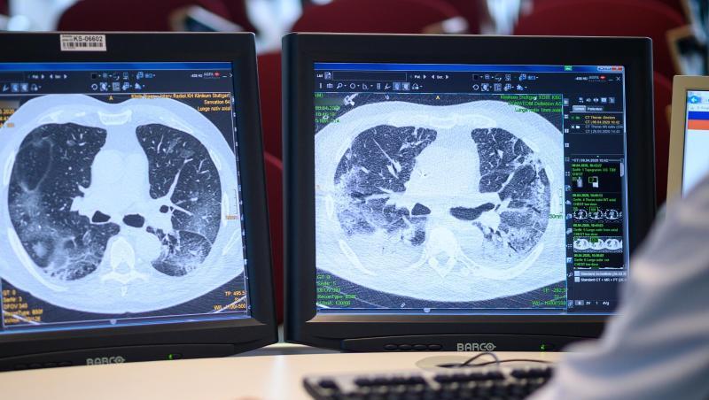 Computertomographieaufnahmen zeigen die Lunge eines Covid-19-Patienten. Computertomographieaufnahmen zeigen die Lunge eines Covid-19-Patienten.