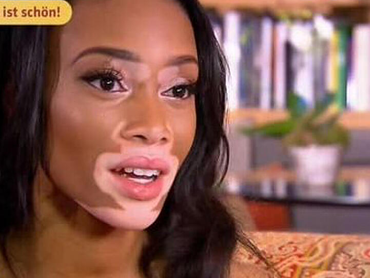 Model Chantelle Winnie leidet an einer Pigmentstörung