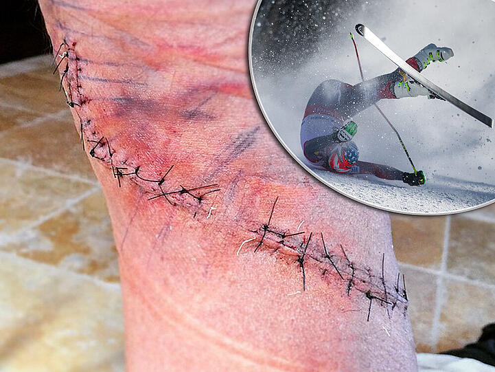 Bode Millers Wunde musste mit "nur ungefähr 50 Stichen" genäht werden