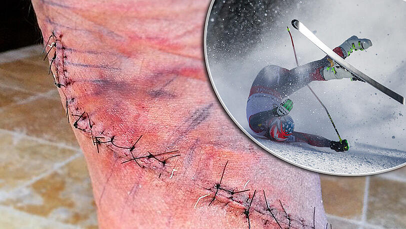 Bode Millers Wunde musste mit "nur ungefähr 50 Stichen" genäht werden Bode Millers Wunde musste mit "nur ungefähr 50 Stichen" genäht werden