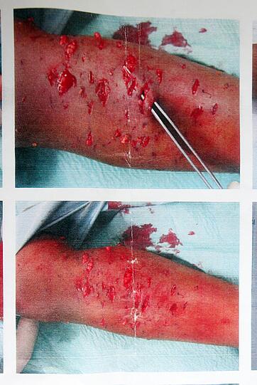 Der wild gewordene Rottweiler hat Cesars Bein übel zugerichtet. Mit 60 Stichen wurden die Wunden genäht. 
Das Kind musste nach der Attacke noch einige Tage im Krankenhaus bleiben. Inzwischen ist das Bein wieder gut verheilt. Trotzdem macht dem Dreijährigen das schlimme Erlebnis noch zu schaffen.