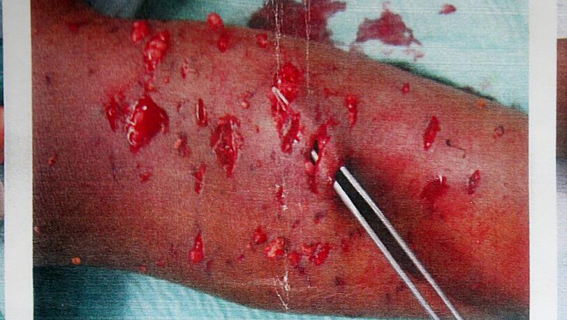 Der wild gewordene Rottweiler hat Cesars Bein übel zugerichtet. Mit 60 Stichen wurden die Wunden genäht.
Das Kind musste nach der Attacke noch einige Tage im Krankenhaus bleiben. Inzwischen ist das Bein wieder gut verheilt. Trotzdem macht dem Dreijährigen das schlimme Erlebnis noch zu schaffen. Der wild gewordene Rottweiler hat Cesars Bein übel zugerichtet. Mit 60 Stichen wurden die Wunden genäht.
Das Kind musste nach der Attacke noch einige Tage im Krankenhaus bleiben. Inzwischen ist das Bein wieder gut verheilt. Trotzdem macht dem Dreijährigen das schlimme Erlebnis noch zu schaffen.