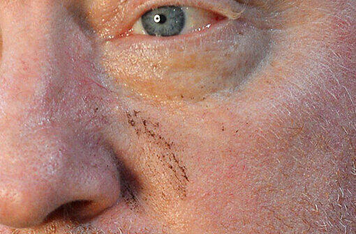 ...wer genau hinsieht, entdeckt diese Schramme unter dem Auge.