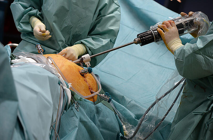 Ärzte in einem baden-württembergischen Krankenhaus führen mit Hilfe des Roboters "da Vinci" eine minimalinvasive Operation im Bauchraum druch.