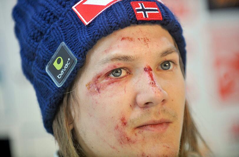 Die Spuren des Horror-Sturzes sind ins Gesicht von Tom Hilde gezeichnet. Doch der Norweger kann schon wieder lachen.