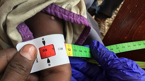 Schon jetzt gelten fast zwei Millionen Kinder in Somalia akut unterern&auml;hrt. (Archivbild)