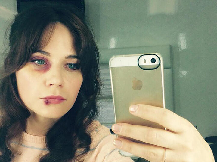 Zooey Deschanel mit blauem Auge und aufgeschlagener Lippe