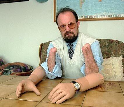 Sechs Jahre lang, bis zur OP, lebte Theo Kelz mit Hand-Prothesen. Selbst damit fuhr er Motorrad.