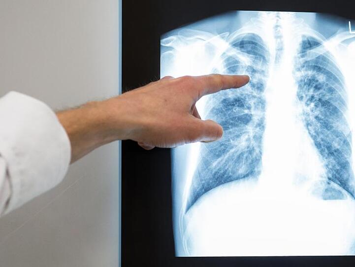 Mehr als hundert Lungenspezialisten bezweifeln den gesundheitlichen Nutzen der aktuellen Grenzwerte für Feinstaub und Stickoxide (NOx).
