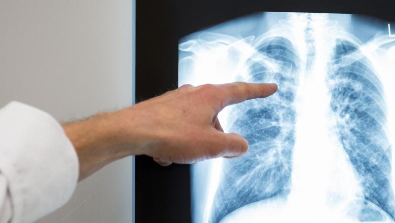 Mehr als hundert Lungenspezialisten bezweifeln den gesundheitlichen Nutzen der aktuellen Grenzwerte für Feinstaub und Stickoxide (NOx). Mehr als hundert Lungenspezialisten bezweifeln den gesundheitlichen Nutzen der aktuellen Grenzwerte für Feinstaub und Stickoxide (NOx).