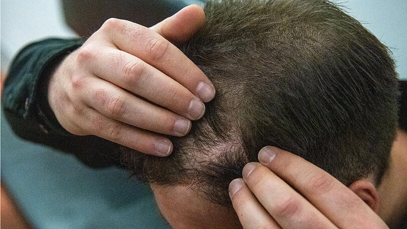 Der Kläger zeigt die Stelle, an der ihm Haare transplantiert wurden.