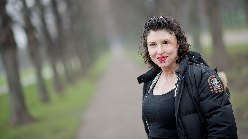 Vor zwei Jahren wurde Vanessa von ihrem Ex-Freund mit Schwefelsäure verätzt. Die Angst ist allgegenwärtig, doch die junge Frau zeigt Stärke.