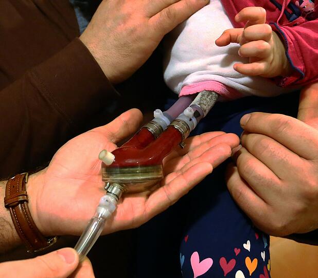 Medinas Leben hängt derzeit an diesem künstlichen Herz. Ohne dieses &bdquo;Berlin Heart&ldquo; wäre sie gestorben.