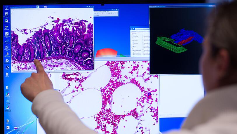 Die Diagnostik hat sich seit Jahren verbessert - nicht nur bei der Behandlung von Darmkrebs, auch bei der Fr&uuml;herkennung. (Illustration)