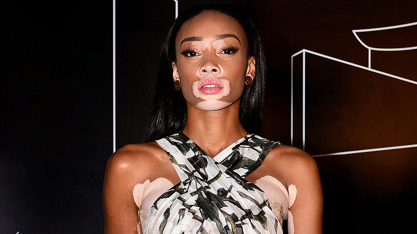 Winnie Harlow nahm an der Castingshow "America's Next Top Model" teil.